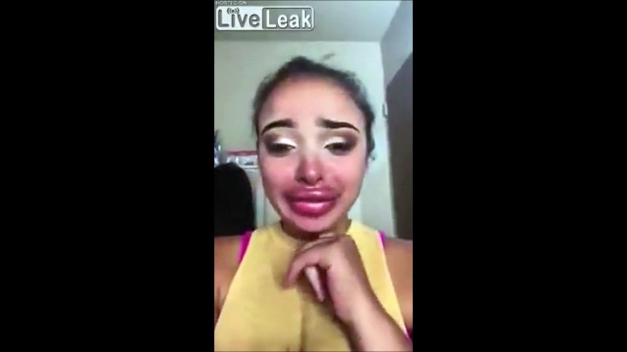 En pleure parce que la chirurgie de ses lèvres est complètement ratée