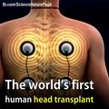 World First Human Head Transplant.