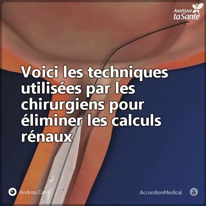 Nous vous expliquons les trois techniques des chirurgiens pour éliminer les calculs rénaux