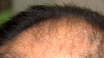 수면 무호흡 환자, 탈모 가능성 최대 7배 / YTN