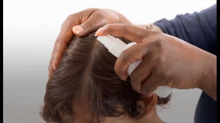 Les poux n’ont jamais été aussi nombreux et arrivent avec trois mois d’avance