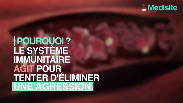 Sida : quels sont les signes précoces du VIH ?