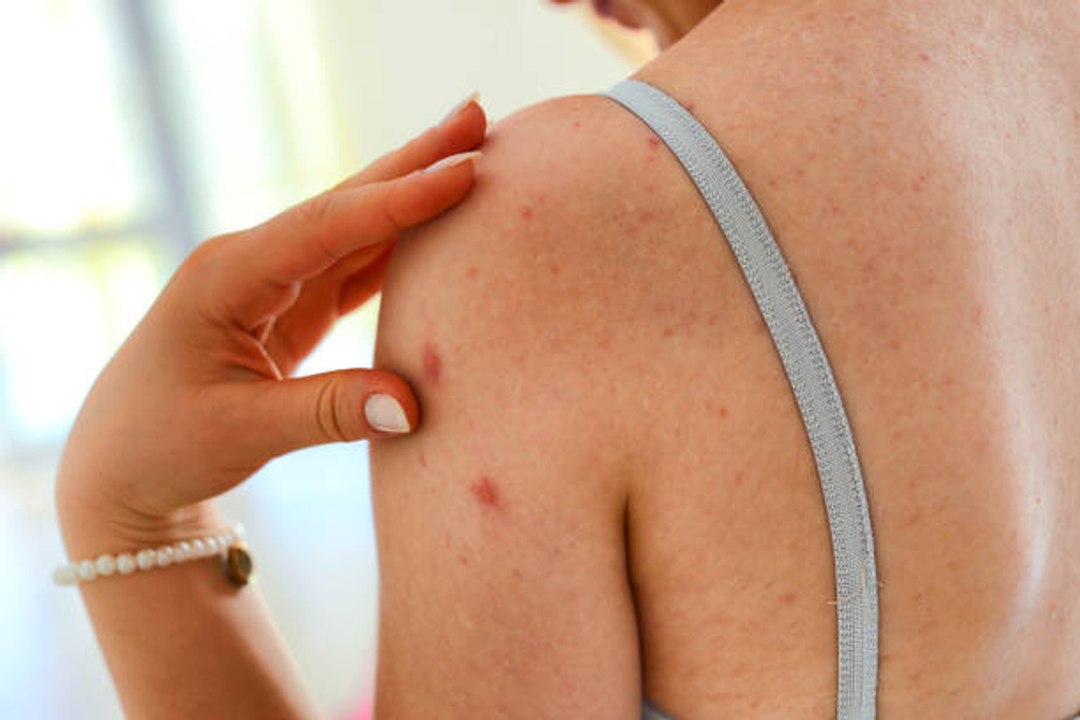 Comment traiter un zona ?