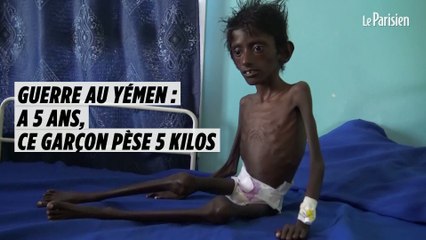 Guerre au Yémen : Abdel Rahmane, 5 ans, pèse 5  kilos