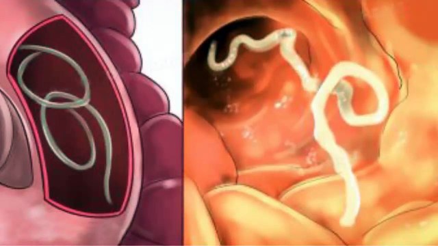 7 Herbs That Treat Internal Parasites Fast