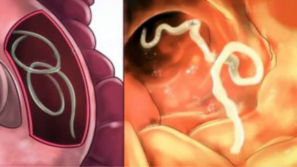 7 Herbs That Treat Internal Parasites Fast