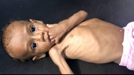 Hunger as a weapon on the rise in conflict zones