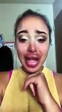 Une fille craque parce sa chirurgie des lèvres est ratée