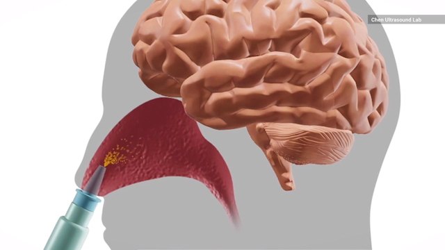 Scientists Are Testing Nasal Spray To Treat Brain Cancer