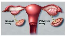 Health Tips - BEST RECIPES FOR CLEANING OVARIES CYSTS