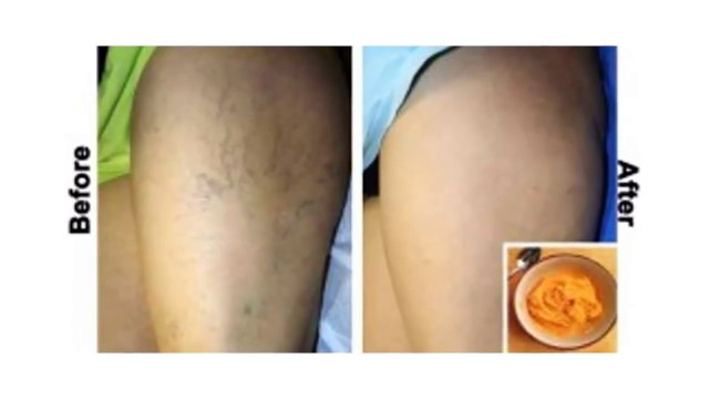This Is The Most Effective Natural Treatment for Varicose Veins!