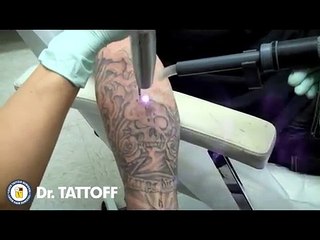 How Does Laser Tattoo Removal Feel