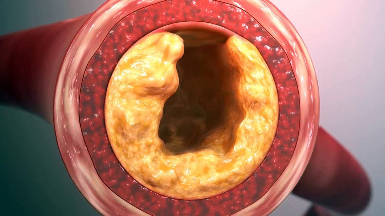 Reduce Cholesterol And Clean Out All Blood Vessels Up to The Heart With This Natural Remedy