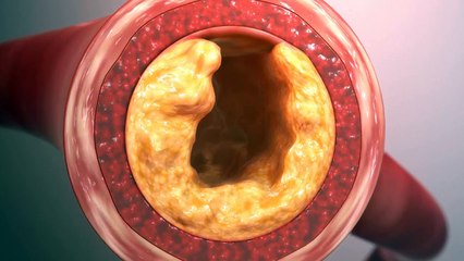 Reduce Cholesterol And Clean Out All Blood Vessels Up to The Heart With This Natural Remedy