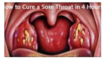 How To Cure Tonsillitis And Sore Throat In Only 4 Hours!