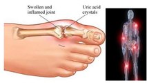 Health News - How to Control Uric Acid Levels