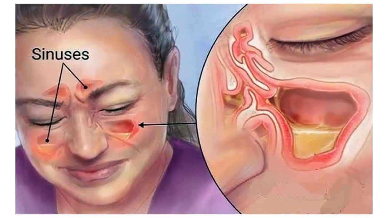 Kill Sinus Infection Within Minutes, With What You Have In Your Kitchen!