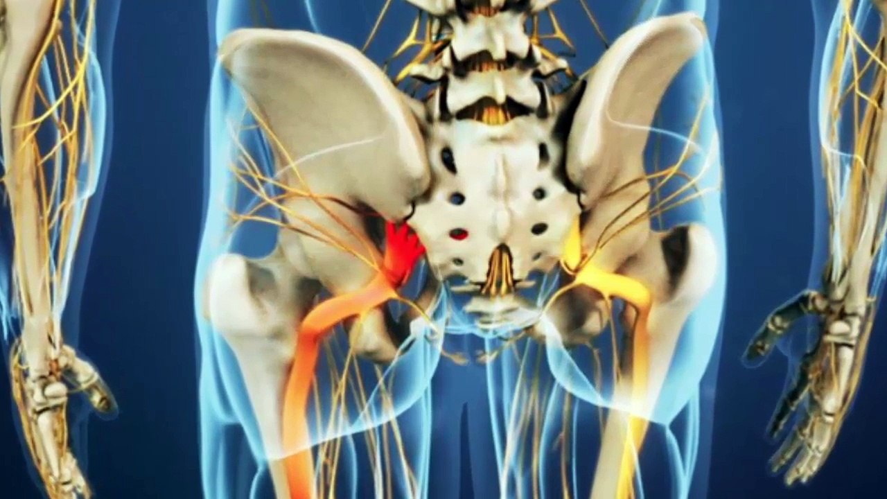 Awesome Home Remedies To Get Rid of Sciatic Nerve Pain Fast! video