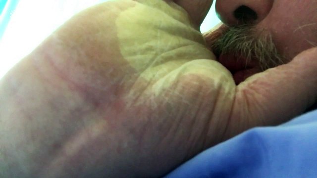 Man's hand inflates like a balloon after allergic reaction