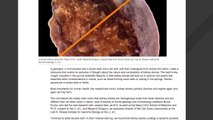 Kidney Stones Found To Have Distinct Geological Histories