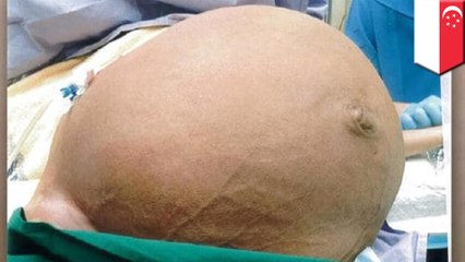28キロの巨大な腫瘍を摘出した女性 - トモニュース