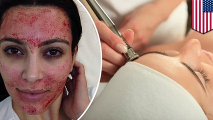 Officials urge 'vampire facial' patients to get tested for