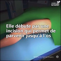 Voici comment une chirurgie réparatrice d'une déviation du genou se déroule