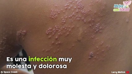¿Qué es y cómo se manifiesta el herpes zoster?