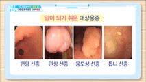 [HEALTHY] Which polyps are prone to cancer ?!, 기분 좋은 날 20180917