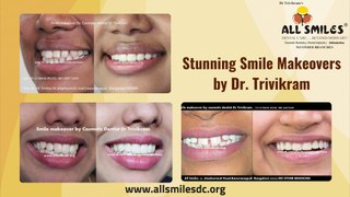 Smile Makeover Treatment in Bangalore | Cosmetic Dentistry | Smile Makeover Procedure in Karnataka