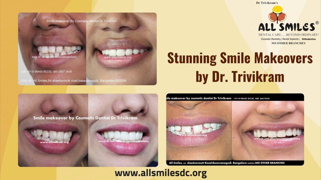 Smile Makeover Treatment in Bangalore | Cosmetic Dentistry | Smile Makeover Procedure in Karnataka