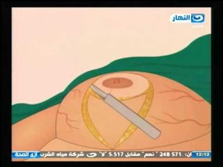 ازي الصحة - اسباب كبر الثدي عند النساء