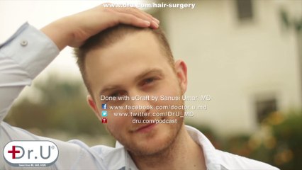 Patient Finds Best Hair Restoration After Years of Failure