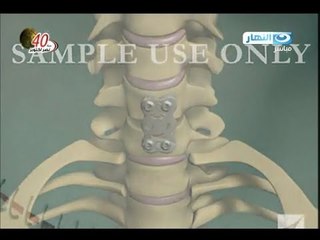 ازى الصحة : آلام العمود الفقرى ومضعفاته - الغضاريف العنقية وتشخيصها وعلاجها