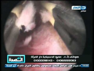 #إزى_الصحة | نزيف الرحم مع الدكتور عمرو الحسينى