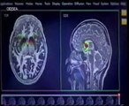 Cerebro adolescente: Adiccion al prono y control de impulsos (Cortex prefrontal)