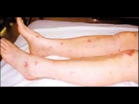 أخر النهار - ارتفاع أعداد المصابين بأعراض حمي الضنك في البحر الأحمر ومخاوف من تفشي المرض !