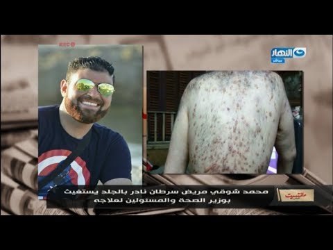 #مانشيت_القرموطي | مريض سرطان نادر يناشد وزير الصحة و محمد_رمضان لتبني حالته