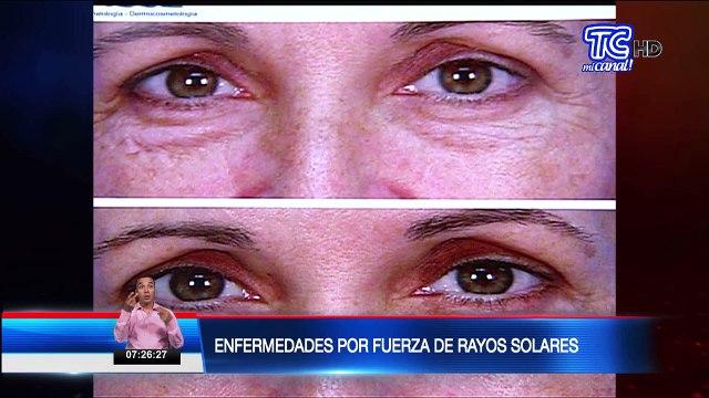 En aumento enfermedades por fuerza de rayos solares