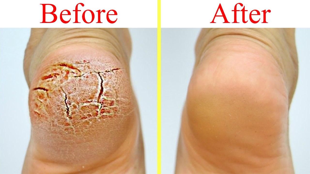 Cracked Heels Treatment at Home DIY: फटी एड़ियों से पाएं छुटकारा | Boldsky