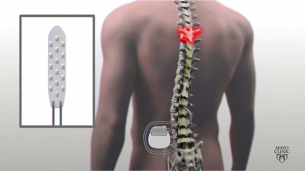 Un parapléjico vuelve a andar gracias a la terapia con electrodos.