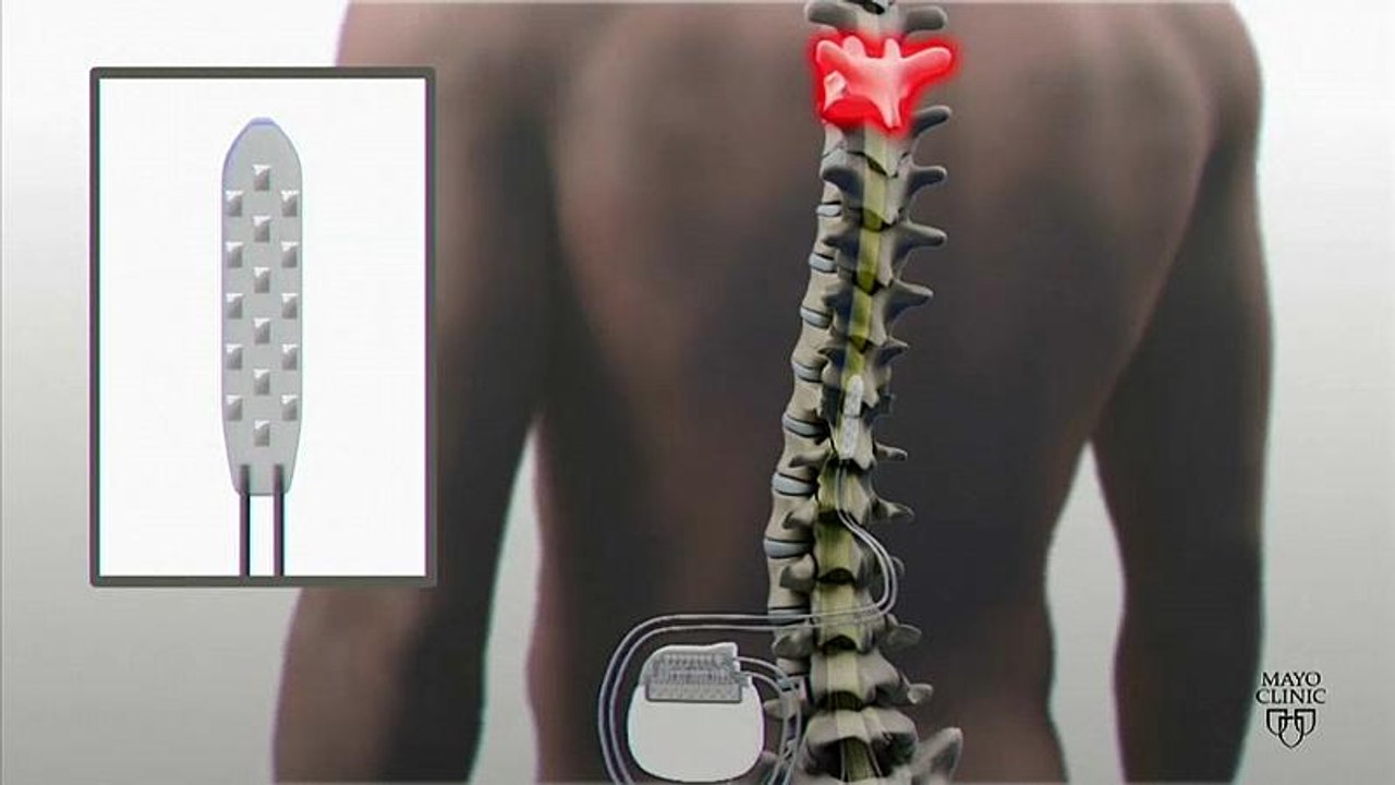 Dank Implantat: Elektrostimulation bringt Gelähmten zum Gehen