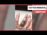 Huge blister develops after laser tattoo removal | SWNS TV