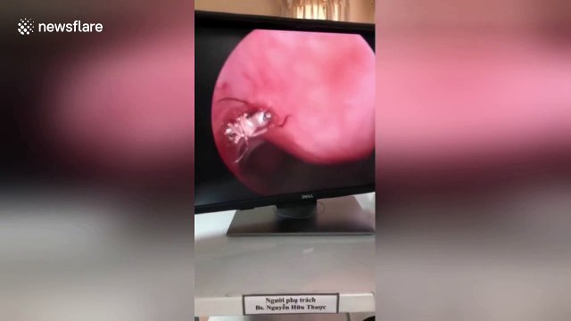 Stomach-churning footage shows twitching mosquito deep inside man's nose