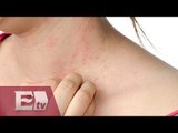 Campaña en el Distrito Federal para prevenir la psoriasis/ Comunidad