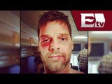Ricky Martin muestra fotografias en las que aparece golpeado / Función con Joanna Vegabiestro