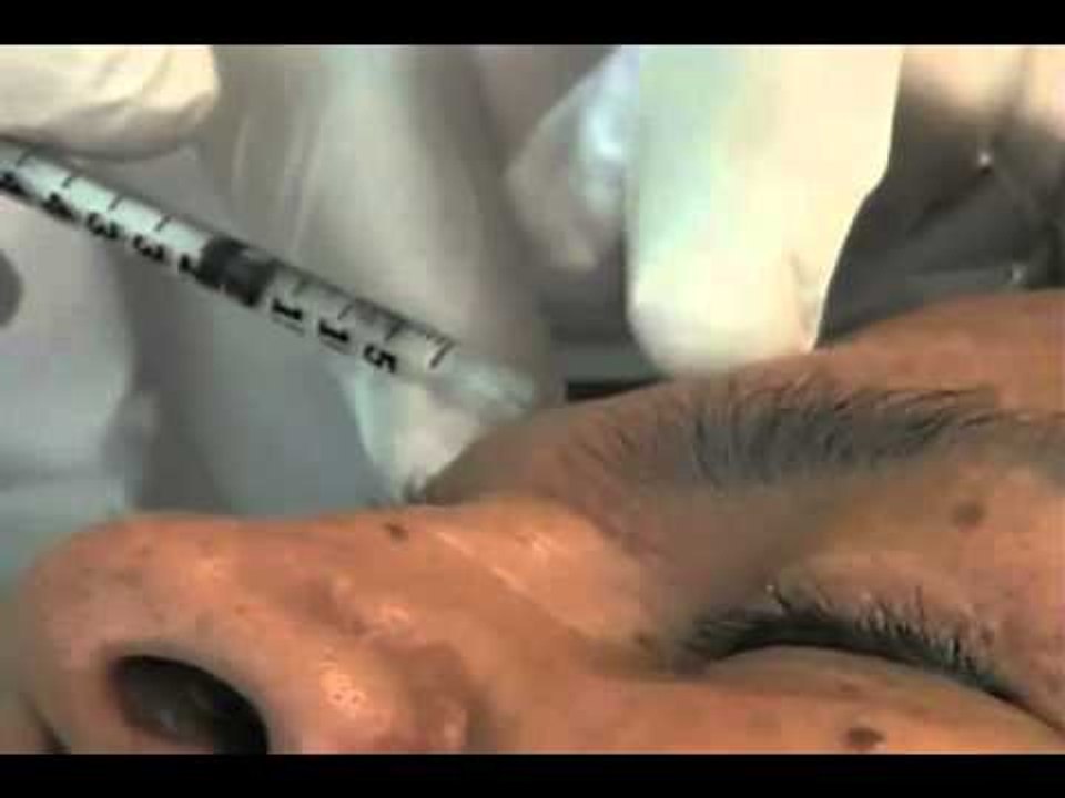 Uso de botox cada vez mas recurrente entre los hombres