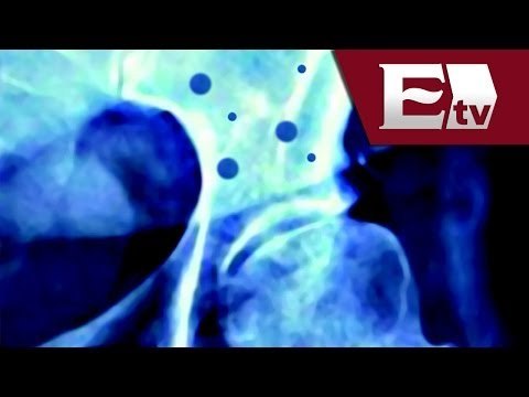 Osteoporosis, características de la enfermedad / Salud con Gloria Contreras