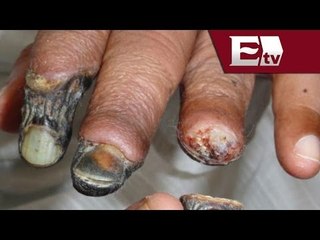 Autoridades confirman primer adicto al 'krokodil' en Sonora / Paola Virrueta