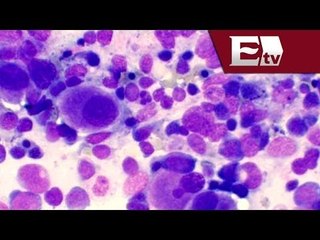 ¿Qué es el síndrome mielodisplásico? / Salud con Gloria Contreras